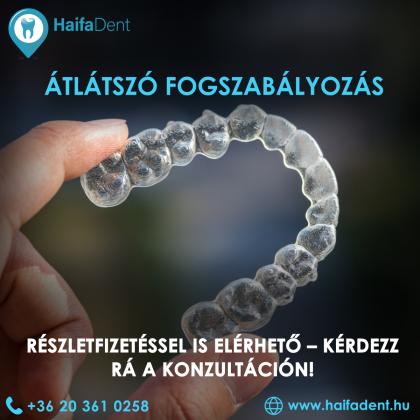 Átlátszó fogszabályozás részletfizetéssel Átlátszó fogszabályozás részletfizetéssel