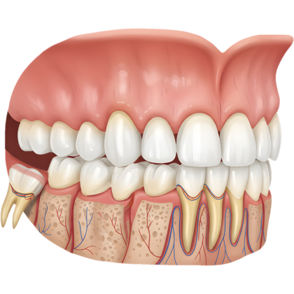 Bölcsességfog műtét menete, árak és tudnivalók - HaifaDent Bölcsességfog műtét menete, árak és tudnivalók - HaifaDent
