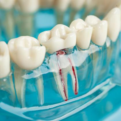 Gyökérkezelés után: fájdalom, tünetek és teendők Gyökérkezelés után: fájdalom, tünetek és teendők