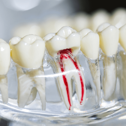 Gyökértömés kisokos